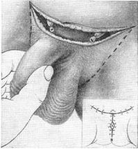 Surgical lengthening of the penis by pulling the hidden part of it